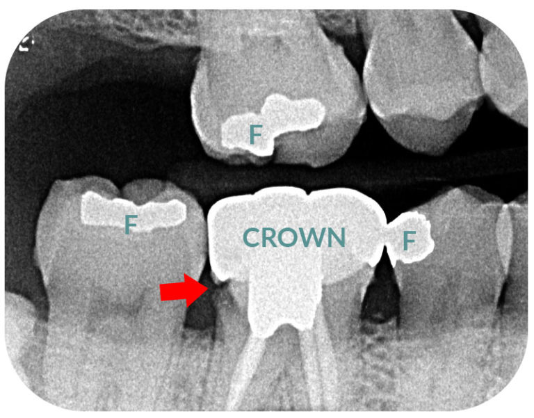 Why Do I Need XRays When I Visit the Dentist? Twinkle Family Dentalcare