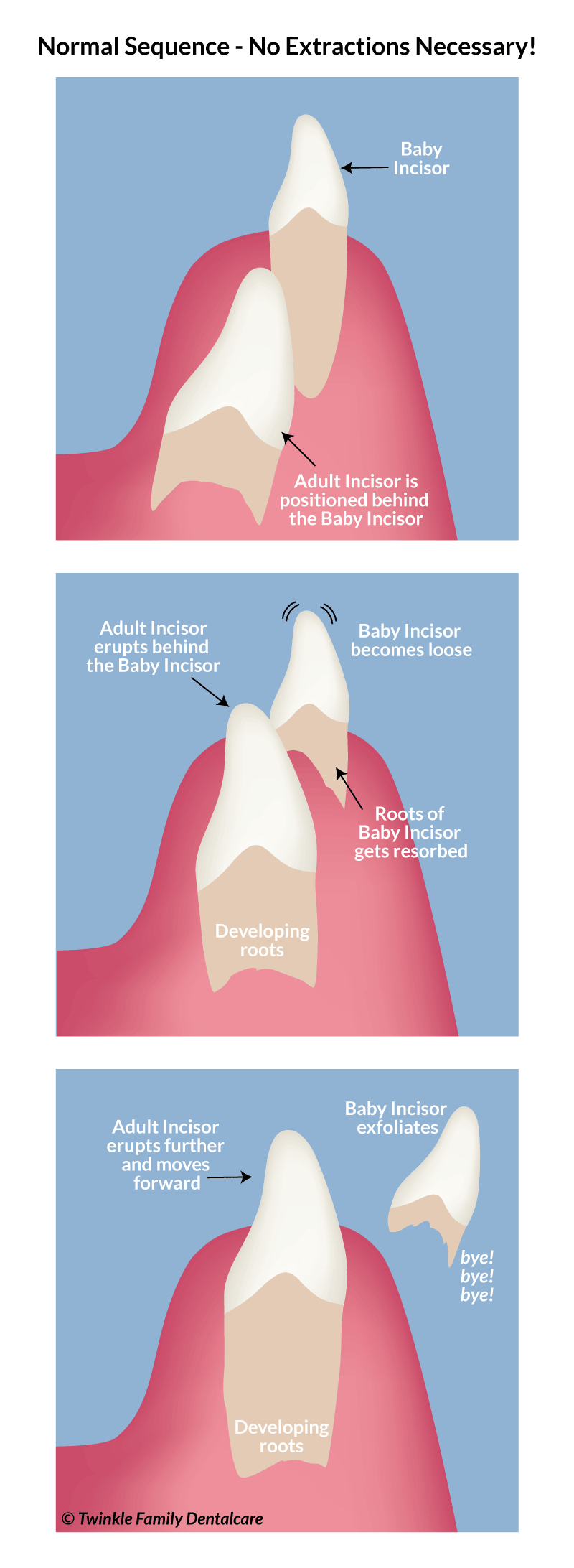 normal sequence where no extractions are necessary